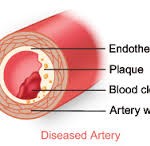 plaque in artery